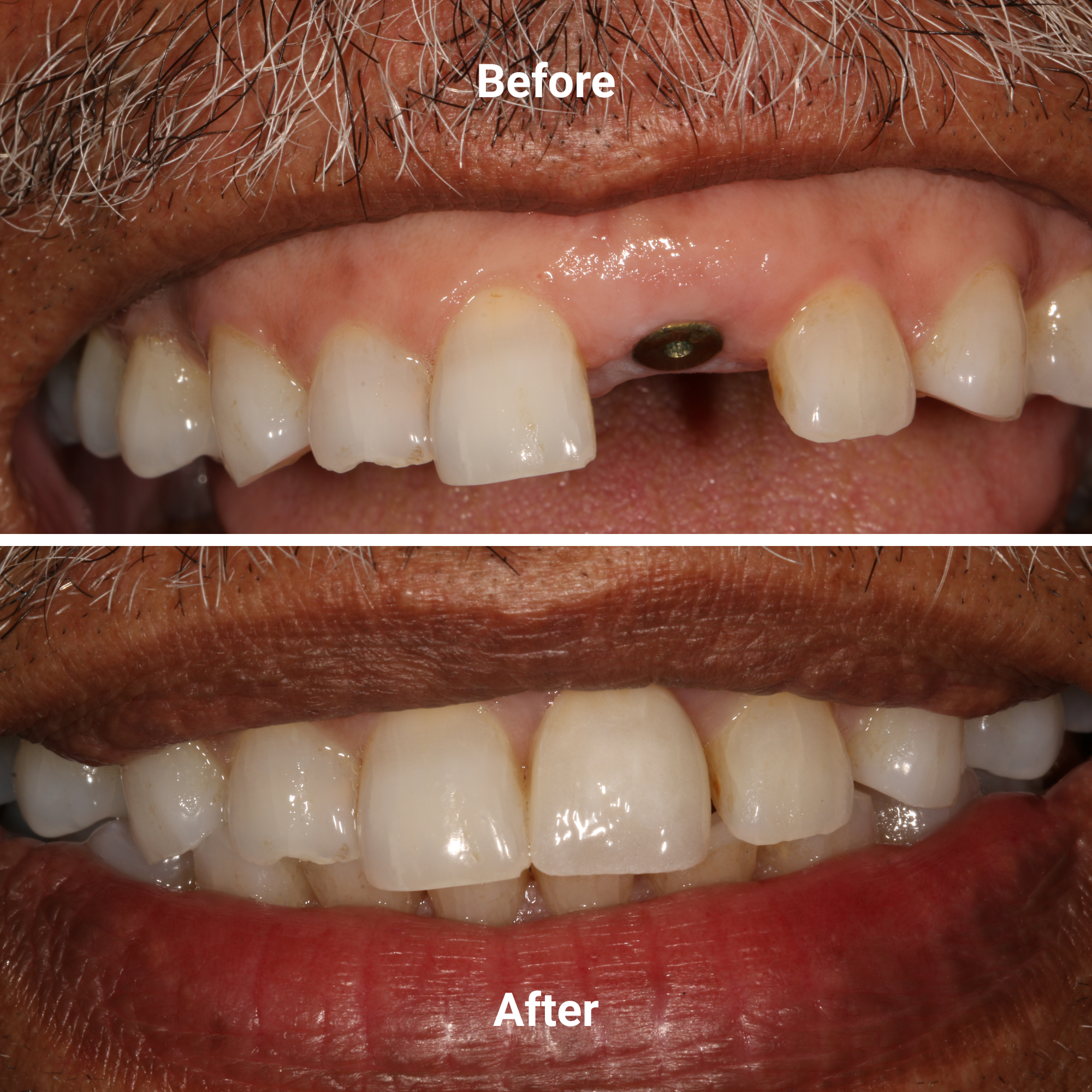 Single implant before and after