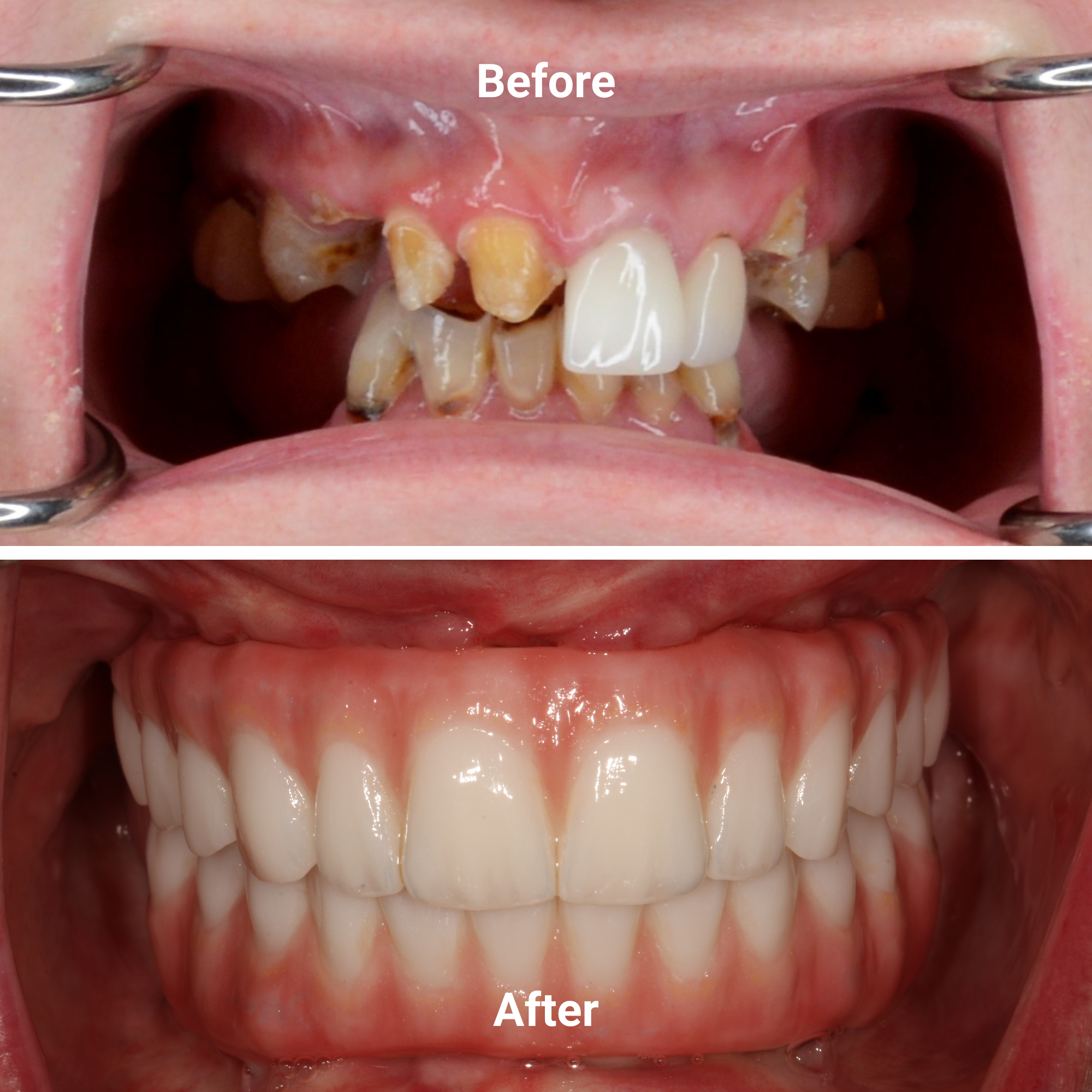 Full arch restoration before and after